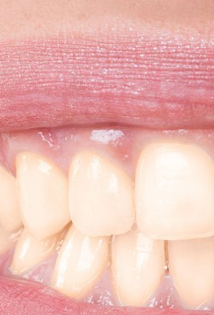 Patient's teeth before visiting Patient First