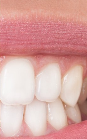 Patient's teeth after visiting Patient First