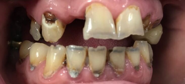 Patient's teeth before visiting Patient First