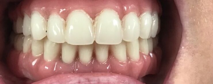 Patient's teeth after visiting Patient First