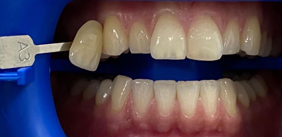 Patient's teeth before visiting Patient First