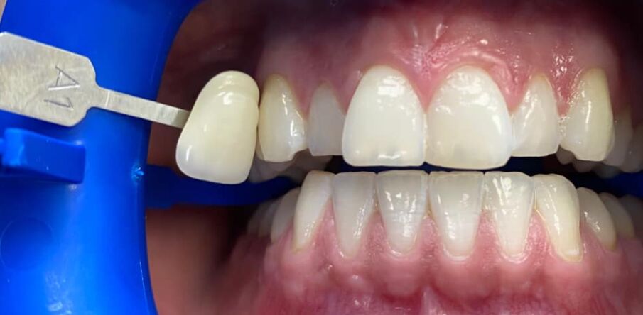 Patient's teeth after visiting Patient First