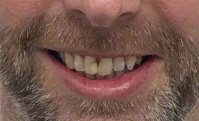 Patient's teeth before visiting Patient First
