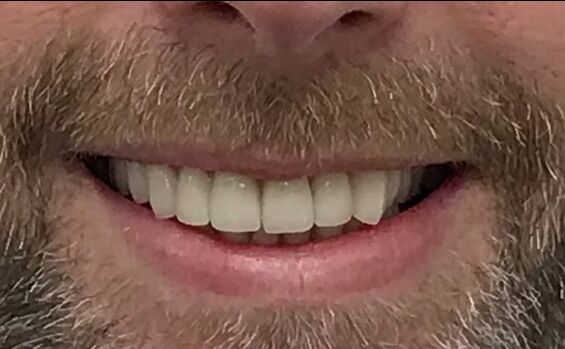 Patient's teeth after visiting Patient First
