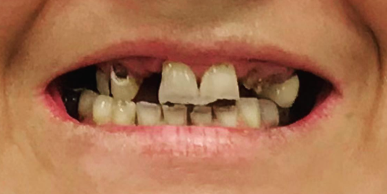 Patient's teeth before visiting Patient First