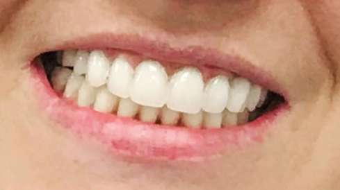 Patient's teeth after visiting Patient First