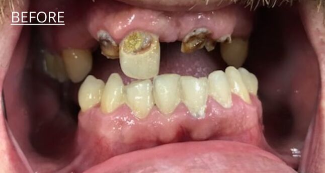 Patient's teeth before visiting Patient First