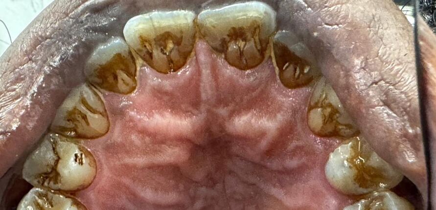 Patient's teeth before visiting Patient First