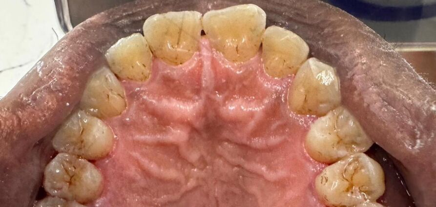 Patient's teeth after visiting Patient First