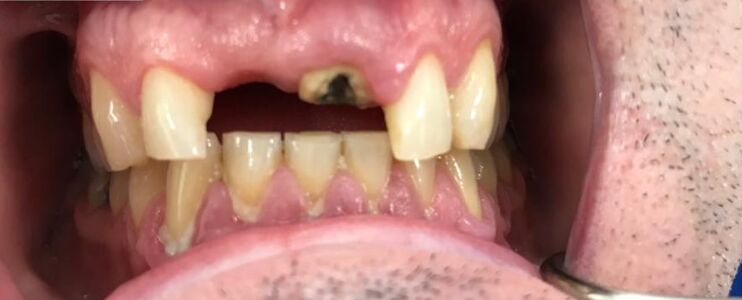 Patient's teeth before visiting Patient First