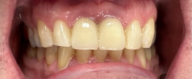 Patient's teeth after visiting Patient First