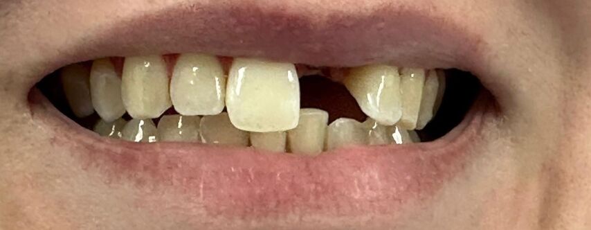 Patient's teeth before visiting Patient First