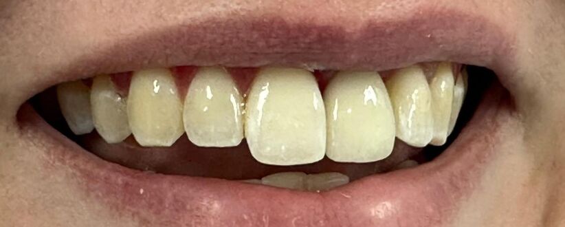 Patient's teeth after visiting Patient First